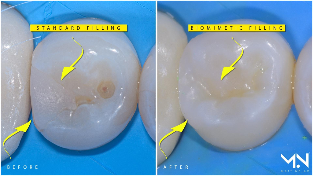 Clinical Macro Comparison: Standard Filling vs Biomimetic Filling