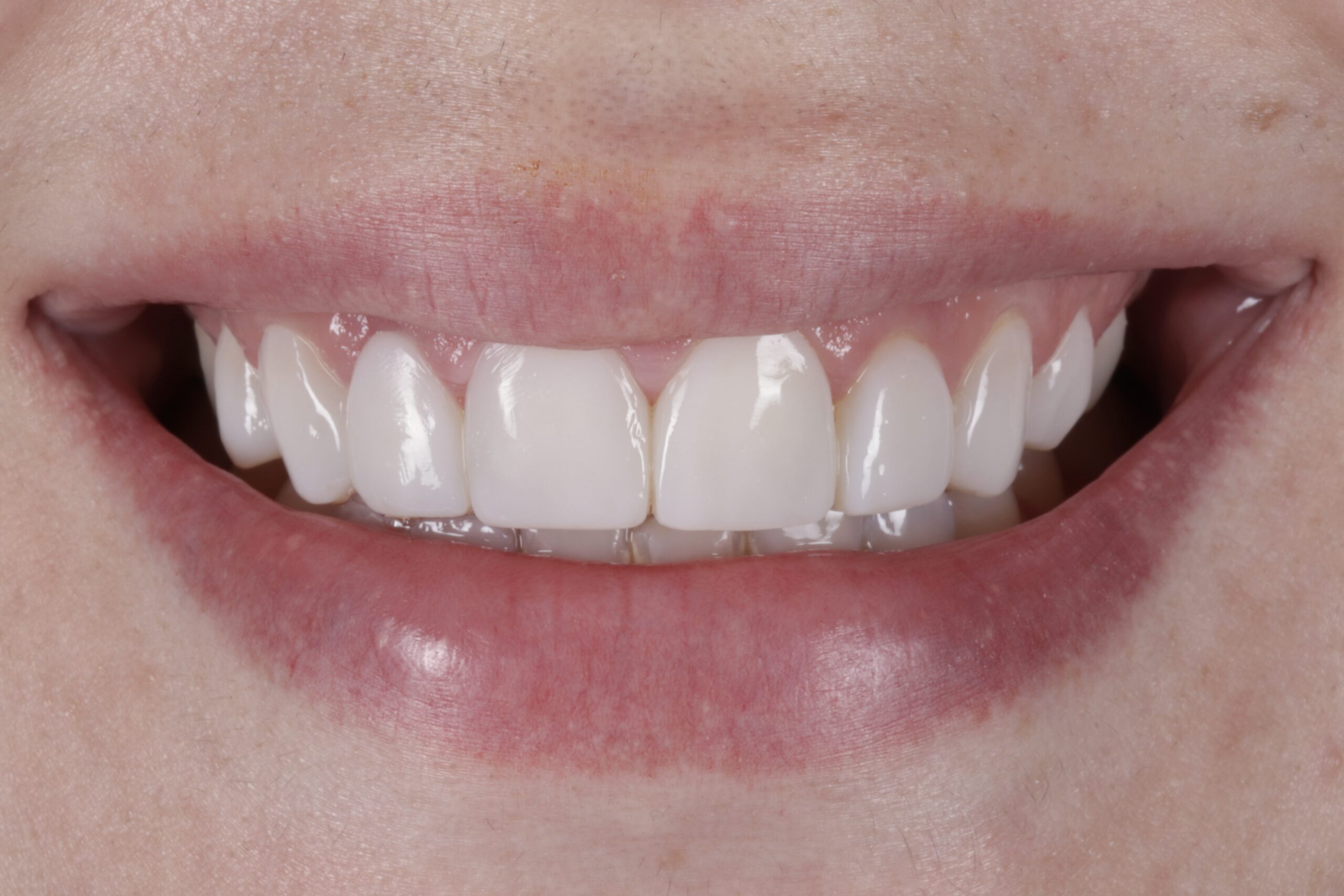 After: Anterior Smile Rejuvenation & Cosmetic Edge Bonding