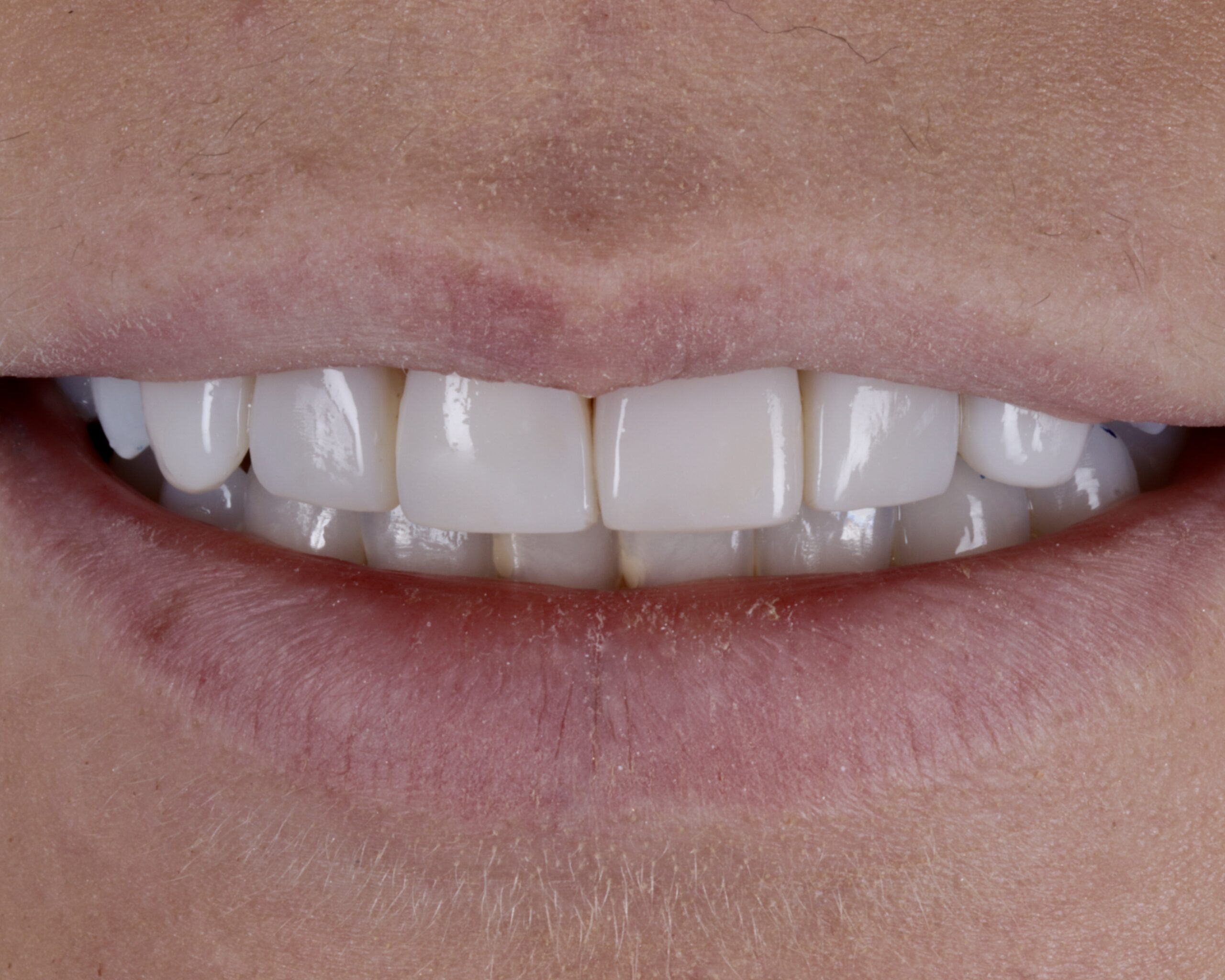 After: Structural Molar Reconstruction Avoiding Root Canal