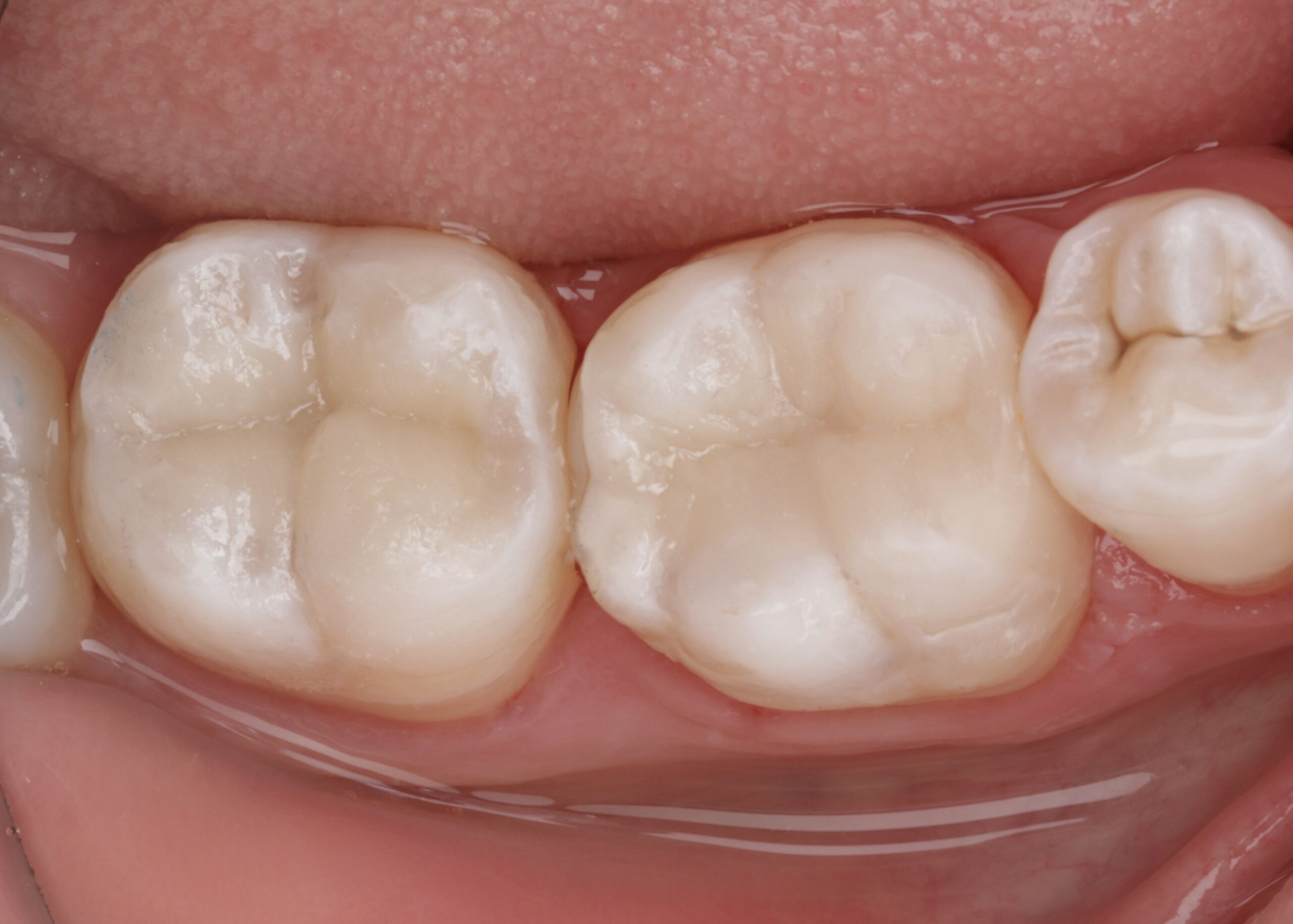After: Defective Fillings to Seamless Tooth-Colored Restorations