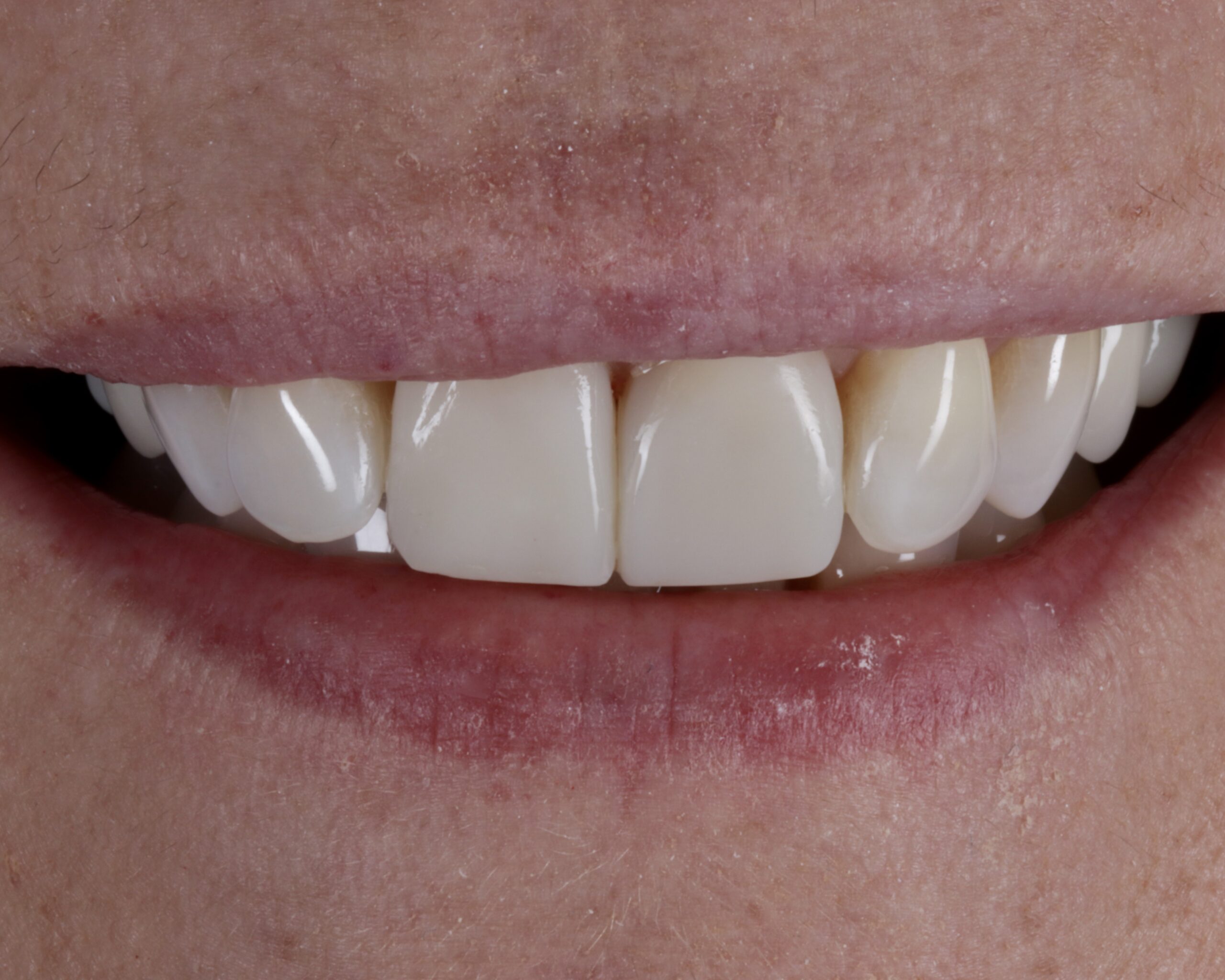 After: Micro-Crack Stabilization & Biomimetic Inlay