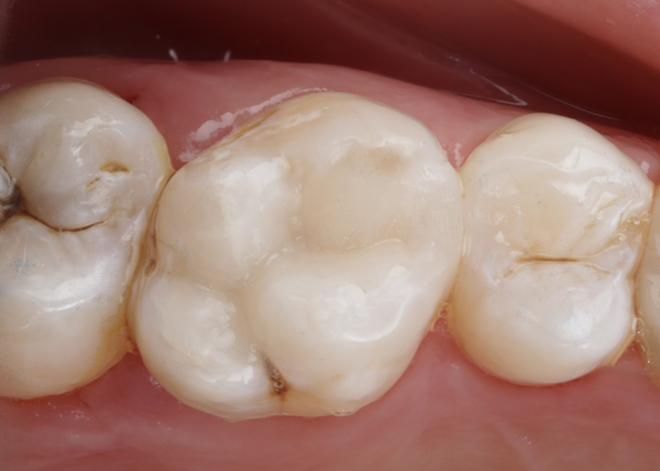 After: Old Amalgam Replacement with Biomimetic Overlays