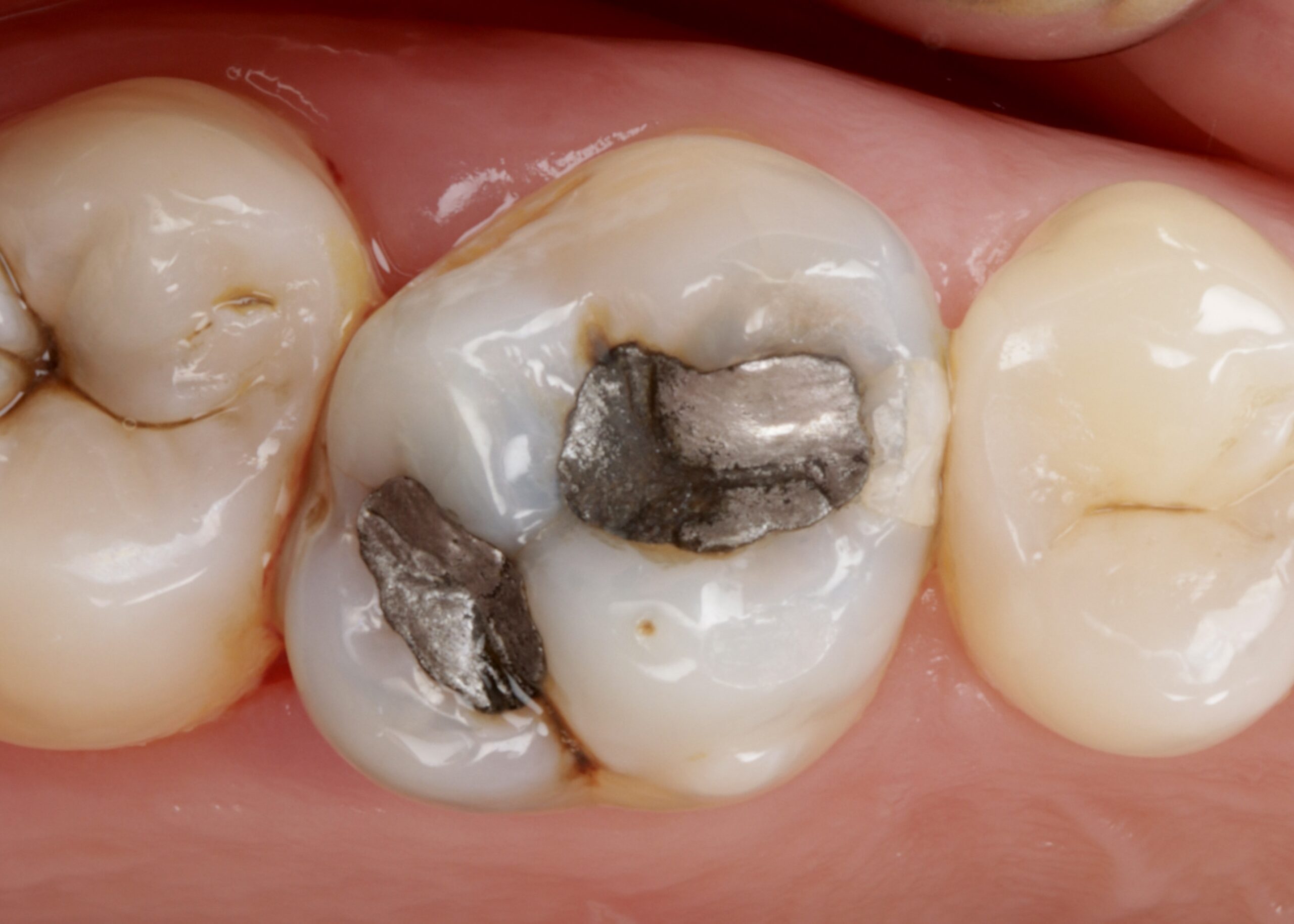 Before: Old Amalgam Replacement with Biomimetic Overlays