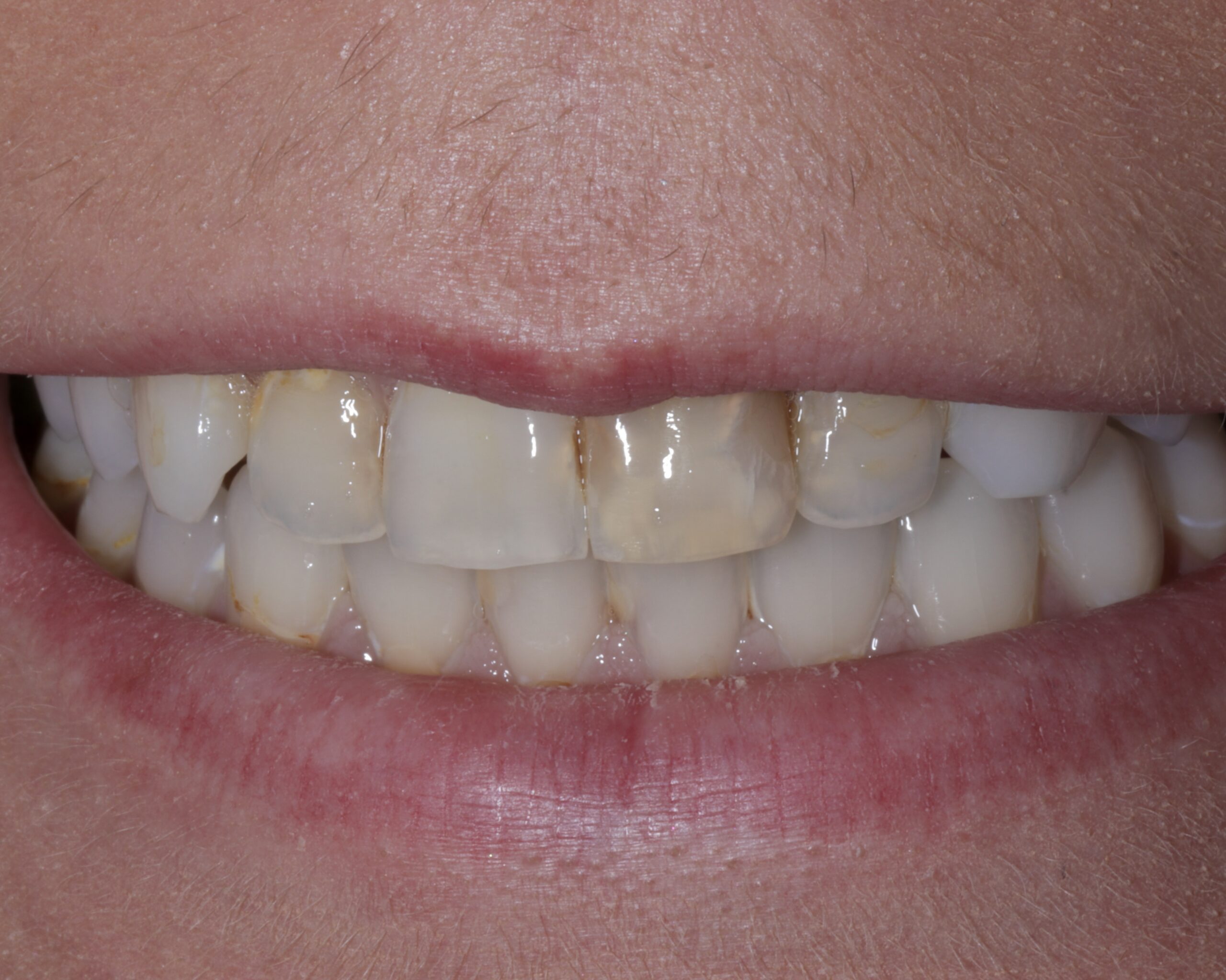 Before: Structural Molar Reconstruction Avoiding Root Canal