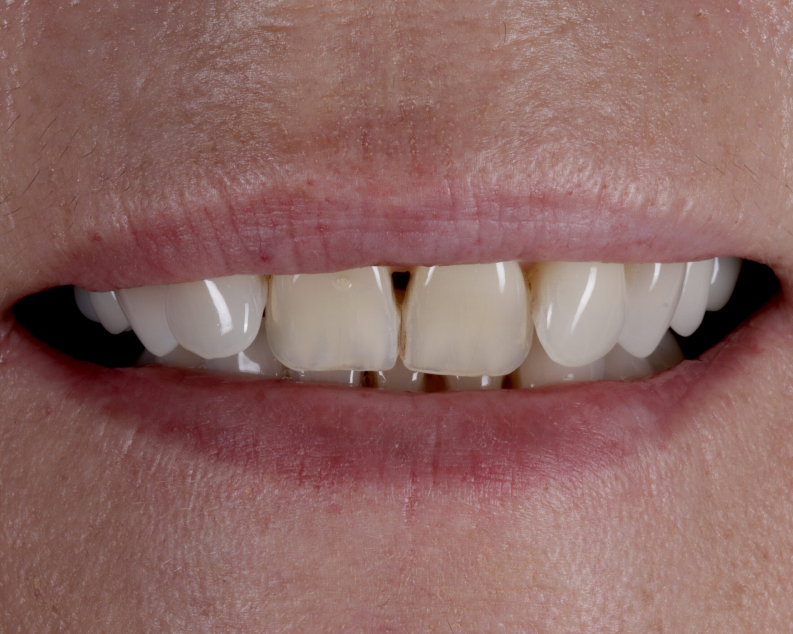 Before: Micro-Crack Stabilization & Biomimetic Inlay