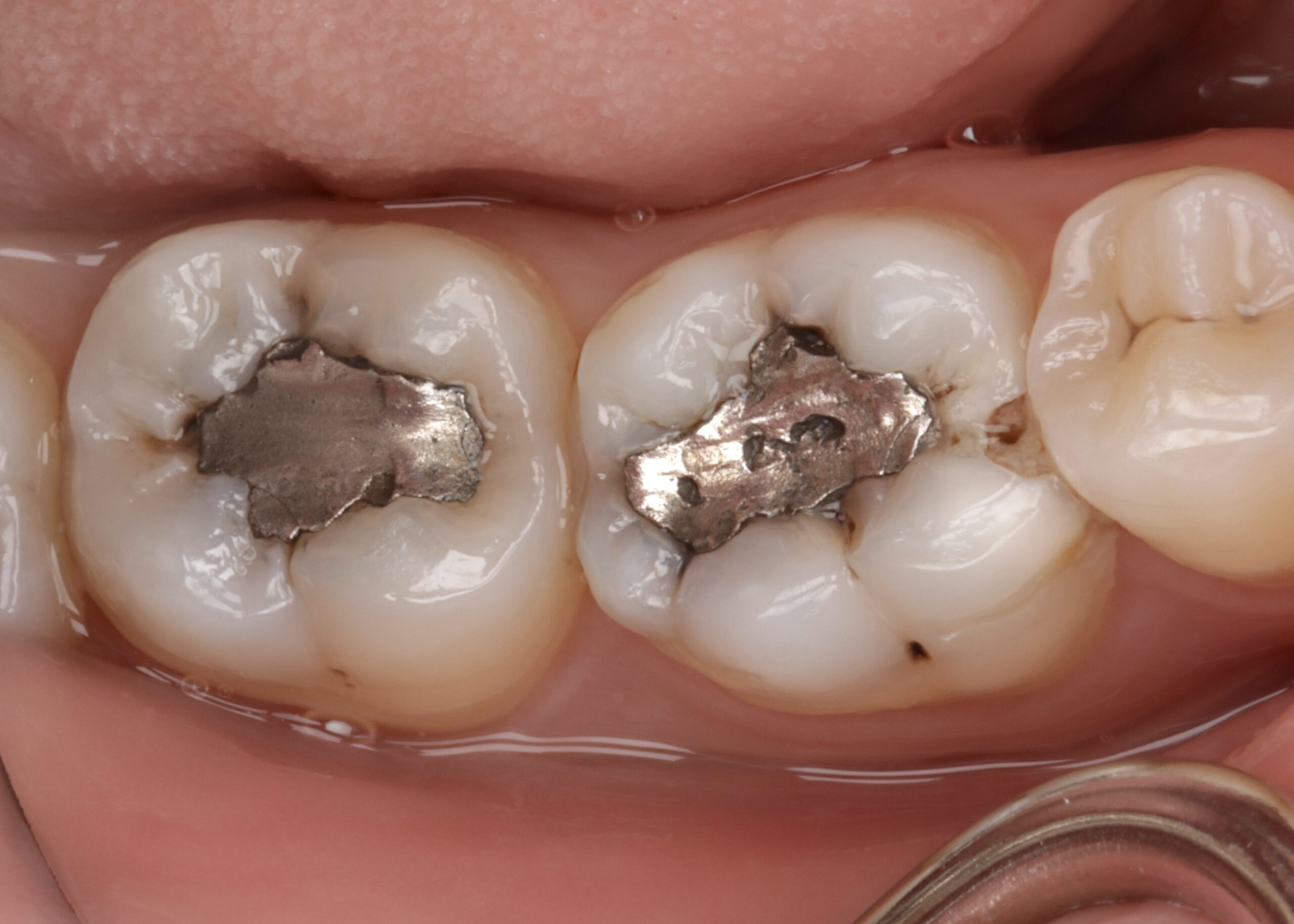 Before: Defective Fillings to Seamless Tooth-Colored Restorations