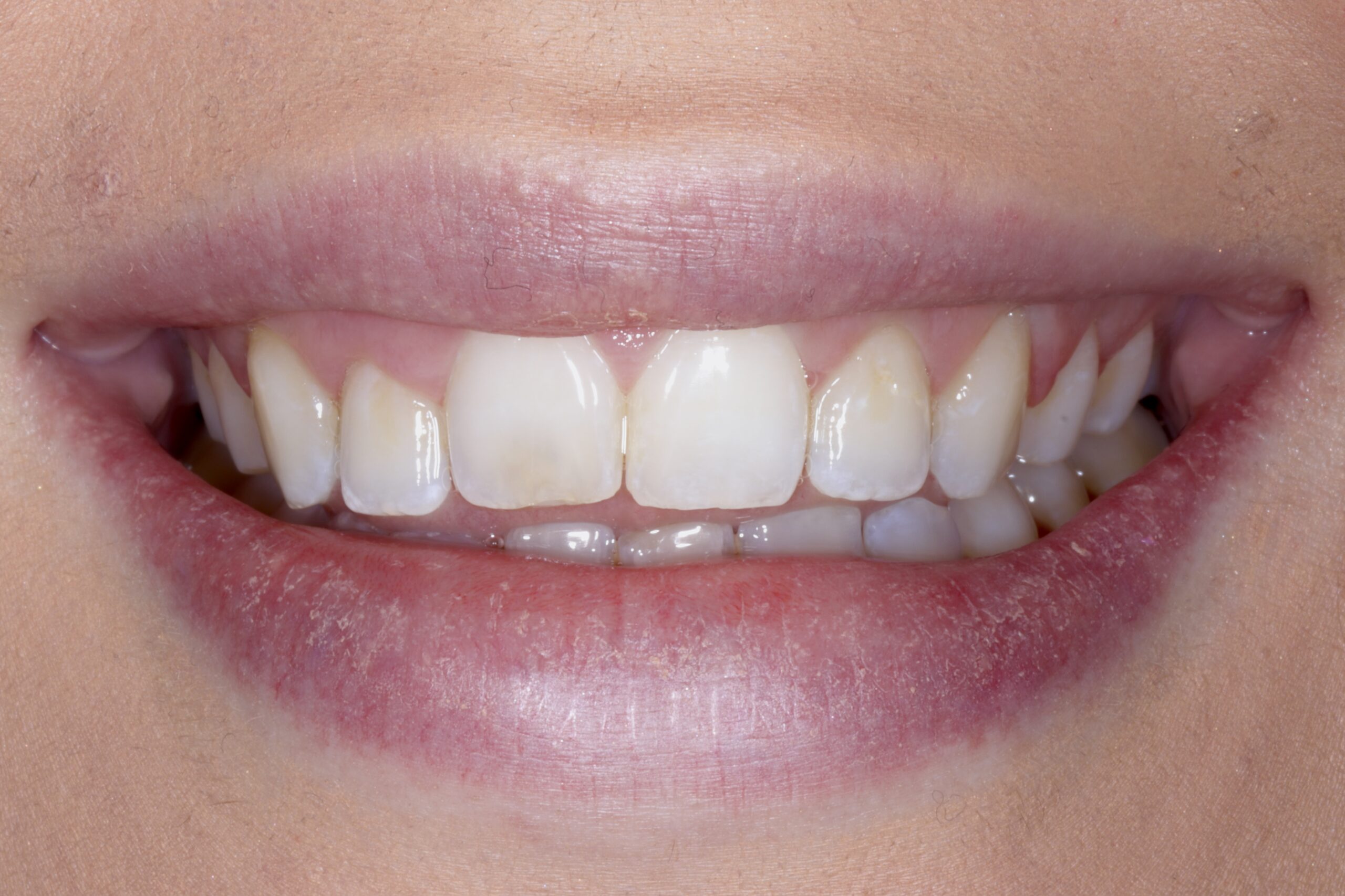 Before: Anterior Smile Rejuvenation & Cosmetic Edge Bonding